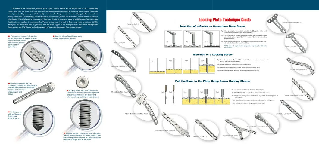 Orthopedic Implant Distal Lateral Fibular Locking Compression Bone Plate
