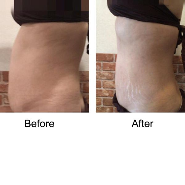 Otesaly Supplier Lipolyitic Solution Fat Reduce Fast Slimming Body Injection Mesotherapy Solution