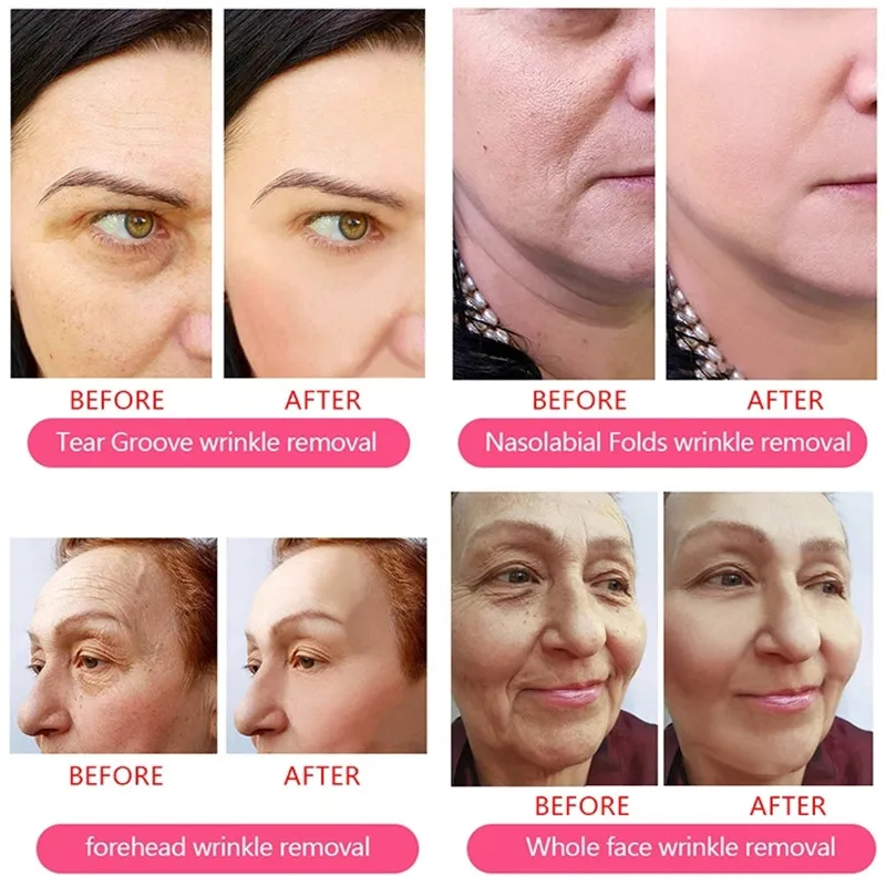 Sculptra Breast Injection Plla Acid Demal Filler