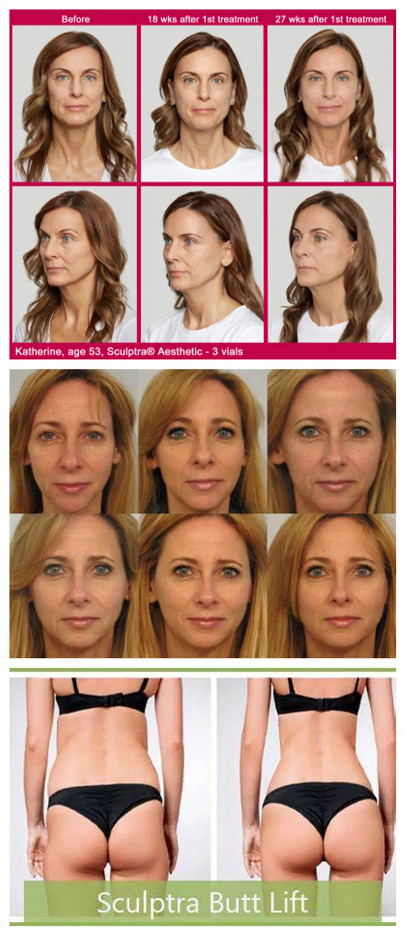 Sculptra Restore Lost Facial Collagen Plla Filler for Wrinkle