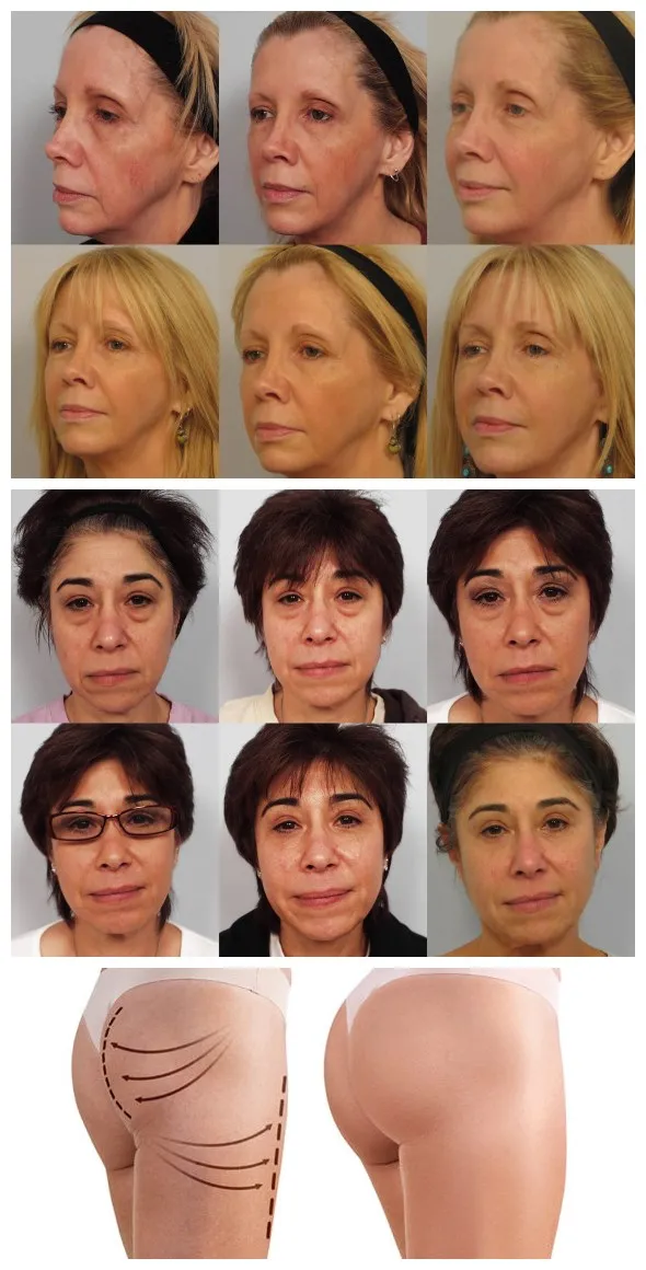 Sculptra Stimulates Collagen Production Plla Powder Poly L Lactic Acid Injection Derm Filler for Face