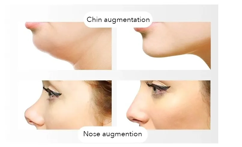 Singfiller Hyaluronic Acid Dermal Filler for Cosmetics