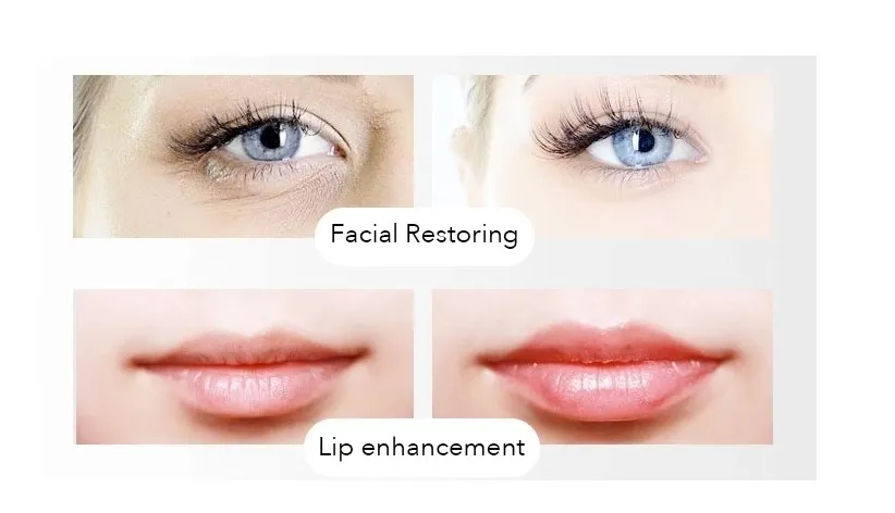 Singfiller Hyaluronic Acid Dermal Filler for Cosmetics