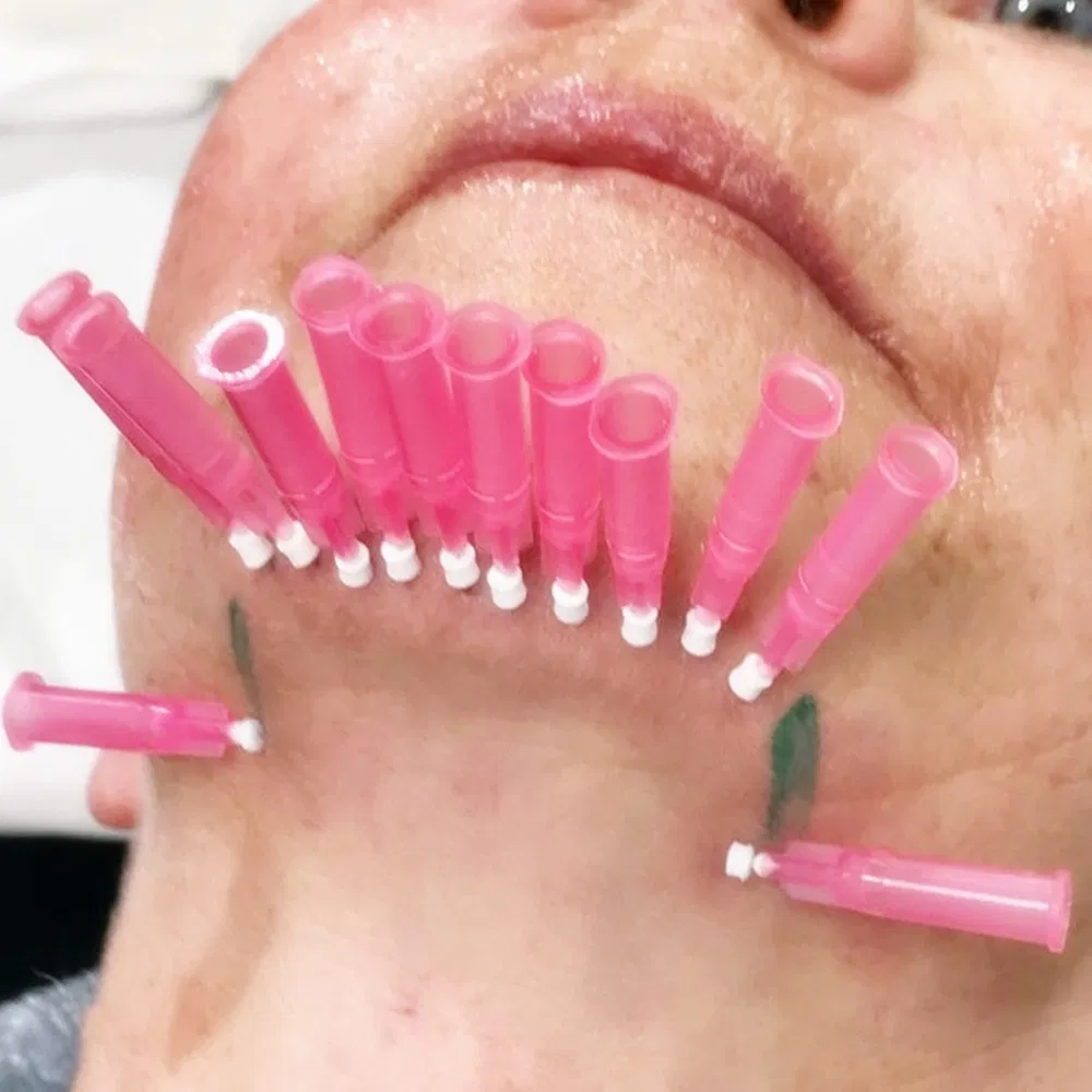 Skin Rejuvenation Mono Tornado Screw Pdo Thread for Skin Lifting
