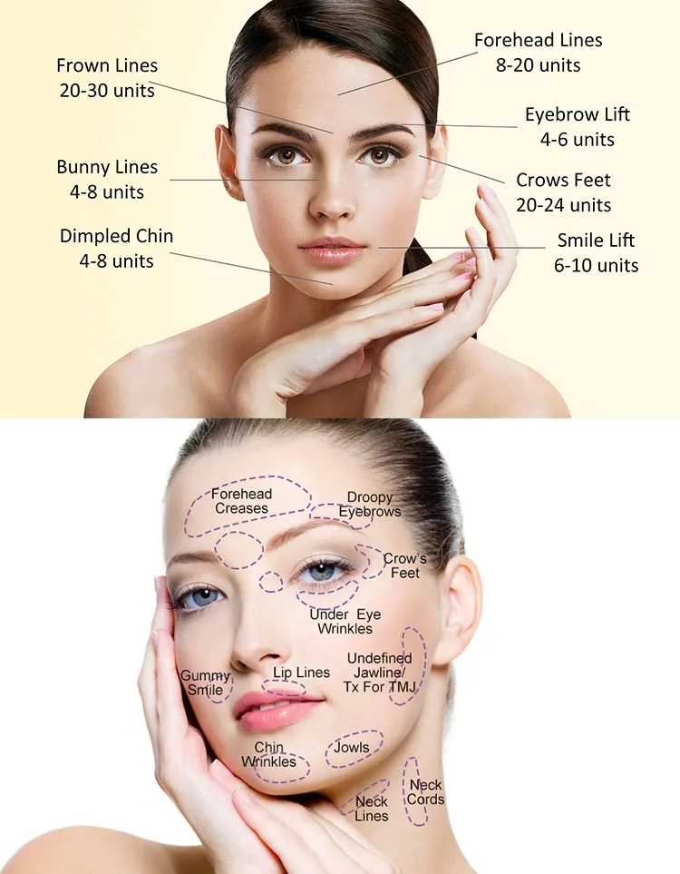 Wholesale Hyaluronic Acid and Innotox Liquid Botax Injection Rentox Hutox Bo Tulax Meditoxin Nabota Btx Wrinkle Removal 50ui 100uid Dermal Filler